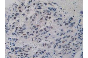 IHC-P analysis of Human Breast Cancer Tissue, with DAB staining. (Nucleolin Antikörper  (AA 388-569))