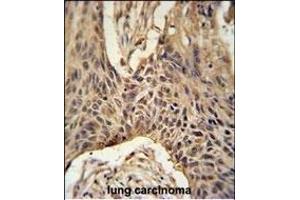LR4 Antibody (C-term) (ABIN651164 and ABIN2840106) immunohistochemistry analysis in formalin fixed and paraffin embedded human lung carcinoma followed by peroxidase conjugation of the secondary antibody and DAB staining. (LPPR4 Antikörper  (C-Term))