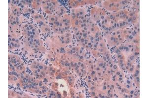 Detection of CK8 in Human Liver cancer Tissue using Polyclonal Antibody to Cytokeratin 8 (CK8)