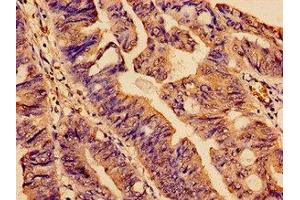 Immunohistochemistry analysis of human colon cancer using ABIN7170866 at dilution of 1:100 (SMC4 Antikörper  (AA 406-501))