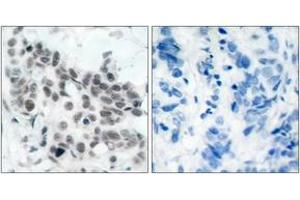 Immunohistochemistry analysis of paraffin-embedded human breast carcinoma, using Retinoblastoma (Phospho-Ser780) Antibody. (Retinoblastoma Protein (Rb) Antikörper  (pSer780))