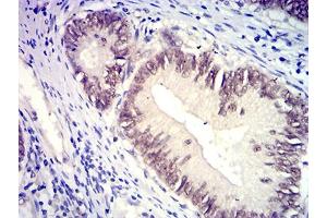 Immunohistochemical analysis of paraffin-embedded rectum cancer tissues using SATB2 mouse mAb with DAB staining. (SATB2 Antikörper  (AA 377-499))
