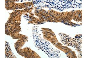 The image on the left is immunohistochemistry of paraffin-embedded Human colon cancer tissue using ABIN7130641(PIWIL4 Antibody) at dilution 1/25, on the right is treated with fusion protein.
