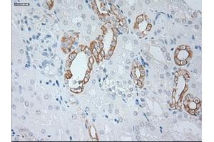 Immunohistochemical staining of paraffin-embedded Carcinoma of kidney tissue using anti-KRT19mouse monoclonal antibody. (Cytokeratin 19 Antikörper  (AA 240-390))