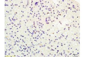 Formalin-fixed and human glioma tissue labeled with Anti-USP-1 Polyclonal Antibody, Unconjugated  at 1:200 followed by conjugation to the secondary antibody and DAB staining (USP1 Antikörper  (AA 701-785))