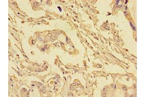 Immunohistochemistry of paraffin-embedded human pancreatic cancer using ABIN7152193 at dilution of 1:100 (eIF4EBP1 Antikörper  (AA 2-111))