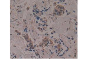 IHC-P analysis of Human Breast Cancer Tissue, with DAB staining. (APOA1BP Antikörper  (AA 118-282))