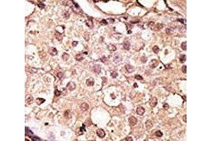 IHC analysis of FFPE human breast carcinoma tissue stained with the ACE2 antibody