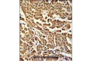 ZN Antibody (C-term) (ABIN651881 and ABIN2840437) immunohistochemistry analysis in formalin fixed and paraffin embedded human skin carcinoma followed by peroxidase conjugation of the secondary antibody and DAB staining.