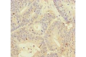 Immunohistochemistry of paraffin-embedded human colon cancer using ABIN7145011 at dilution of 1:100 (YME1L1 Antikörper  (AA 1-240))