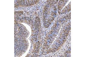 IHC analysis of SART1 using anti-SART1 antibody (ABIN7599884). (SART1 Antikörper  (AA 125-800))