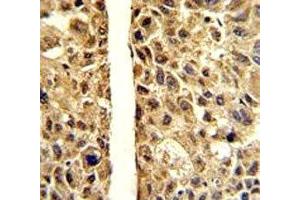IHC analysis of FFPE human hepatocarcinoma stained with ARG1 antibody