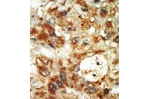 Formalin-fixed and paraffin-embedded human cancer tissue (hepatocarcinoma) reacted with the primary antibody, which was peroxidase-conjugated to the secondary antibody, followed by AEC staining. (MAPK12 Antikörper  (Middle Region))