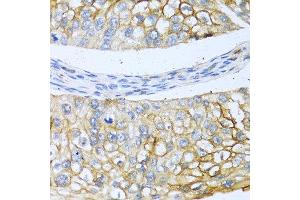Immunohistochemistry of paraffin-embedded human prostate cancer using BMP4 antibody at dilution of 1:100 (40x lens). (BMP4 Antikörper)