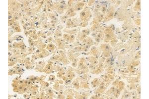ABIN6256727 and ABIN6267256 at 1/100 staining human hepatocellular carcinoma by IHC-P.