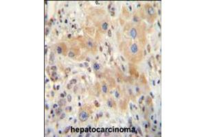 NR0B2 antibody immunohistochemistry analysis in formalin fixed and paraffin embedded human hepatocarcinoma followed by peroxidase conjugation of the secondary antibody and DAB staining. (NR0B2 Antikörper  (AA 56-83))