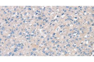 Immunohistochemistry of paraffin-embedded Human liver cancer using SNX3 Polyclonal Antibody at dilution of 1:30 (Sorting Nexin 3 Antikörper)