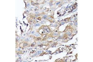 Immunohistochemistry of paraffin-embedded human lung cancer using MLST8 Rabbit pAb (ABIN6131371, ABIN6143894, ABIN6143895 and ABIN6217660) at dilution of 1:100 (40x lens). (GBL Antikörper  (AA 1-326))