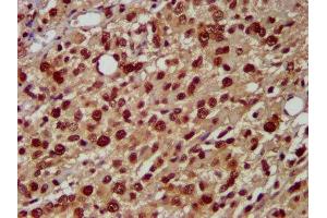IHC image of ABIN7155093 diluted at 1:500 and staining in paraffin-embedded human glioma performed on a Leica BondTM system. (HNRNPAB Antikörper  (AA 1-68))