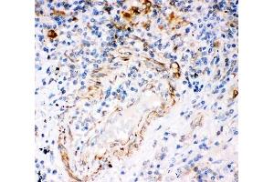 IHC-P: IP3R antibody testing of human lung cancer tissue