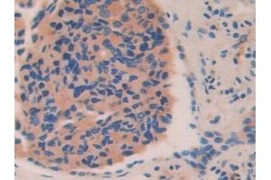 Detection of HEXb in Human Prostate cancer Tissue using Polyclonal Antibody to Hexosaminidase B Beta (HEXb)