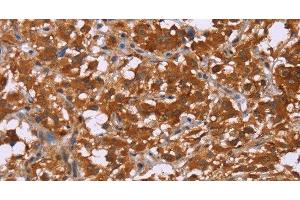 Immunohistochemistry of paraffin-embedded Human thyroid cancer tissue using DCBLD2 Polyclonal Antibody at dilution 1:50 (DCBLD2 Antikörper)