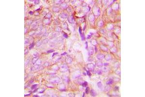 Immunohistochemical analysis of PKC delta (pY313) staining in human breast cancer formalin fixed paraffin embedded tissue section. (PKC delta Antikörper  (pTyr313))