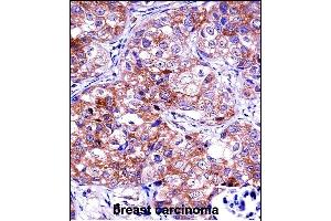 IDH1 Antibody (C-term) ((ABIN657472 and ABIN2846500))immunohistochemistry analysis in formalin fixed and paraffin embedded human breast carcinoma followed by peroxidase conjugation of the secondary antibody and DAB staining. (IMPDH1 Antikörper  (C-Term))