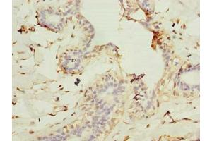 Immunohistochemistry of paraffin-embedded human breast cancer using ABIN7147425 at dilution of 1:100 (Cep76 Antikörper  (AA 241-550))