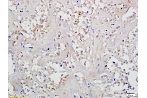 Formalin-fixed and paraffin embedded human gastric cancer labeled with Anti-HIF-1? (Histone H1.5 Antikörper  (AA 681-789))