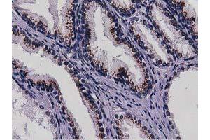 Immunohistochemical staining of paraffin-embedded Carcinoma of Human kidney tissue using anti-NT5DC1 mouse monoclonal antibody. (NT5DC1 Antikörper)