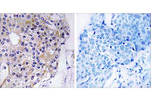 Peptide - +Immunohistochemistry analysis of paraffin-embedded human breast carcinoma tissue using CEP110 antibody. (Centriolin Antikörper)