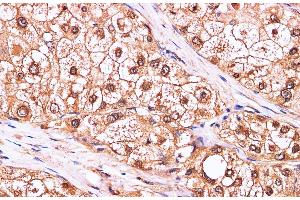 Immunohistochemistry of paraffin-embedded Human liver cancer using CDK4 Polyclonal Antibody at dilution of 1:100 (CDK4 Antikörper)