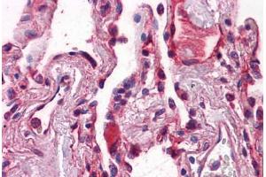 Immunohistochemistry (Formalin-fixed Paraffin-embedded Sections) (IHC (fp)) image for anti-Cadherin 1, Type 1, E-Cadherin (Epithelial) (CDH1) (AA 381-481) antibody (ABIN574222)
