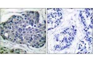 Immunohistochemistry analysis of paraffin-embedded human breast carcinoma, using Acetyl-CoA Carboxylase (Phospho-Ser80) Antibody. (Acetyl-CoA Carboxylase Antikörper  (pSer80))