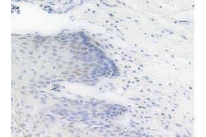 Phospho-PHB2 (Ser39) Antibody at 1/100 staining human cervical carcinoma by IHC-P. (Prohibitin 2 Antikörper  (pSer39))