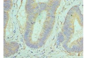 Immunohistochemistry of paraffin-embedded human colon cancer using ABIN7154290 at dilution of 1:100 (GOLM1 Antikörper  (AA 112-401))