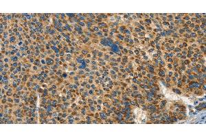 Immunohistochemistry of paraffin-embedded Human liver cancer tissue using IFT74 Polyclonal Antibody at dilution 1:60 (IFT74 Antikörper)