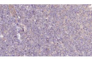ABIN6273059 at 1/100 staining Human lymph cancer tissue by IHC-P. (NAPRT1 Antikörper  (Internal Region))
