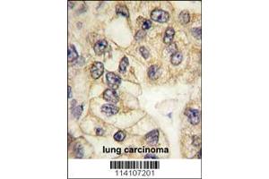 Formalin-fixed and paraffin-embedded human lung carcinoma tissue reacted with CD14 antibody (C-term), which was peroxidase-conjugated to the secondary antibody, followed by DAB staining. (CD14 Antikörper  (C-Term))