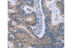 Immunohistochemistry of Human colon cancer using HYAL3 Polyclonal Antibody at dilution of 1:40 (HYAL3 Antikörper)