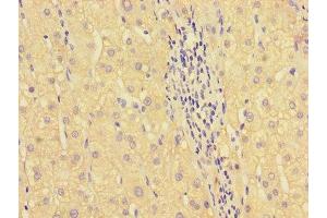 Immunohistochemistry of paraffin-embedded human liver cancer using ABIN7155713 at dilution of 1:100 (HOXA2 Antikörper  (AA 26-124))