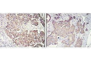 Immunohistochemical analysis of paraffin-embedded galactophore tumour using ERBB2 mouse mAb with DAB staining (ErbB2/Her2 Antikörper  (AA 750-987))