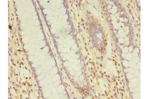 Immunohistochemistry of paraffin-embedded human colon cancer using ABIN7164329 at dilution of 1:100 (NARS2 Antikörper  (AA 15-210))