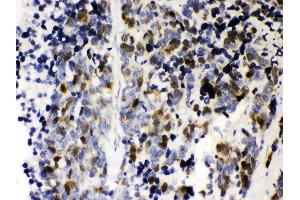 Anti- Cyclin A2 Picoband antibody, IHC(P) IHC(P): Human Lung Cancer Tissue