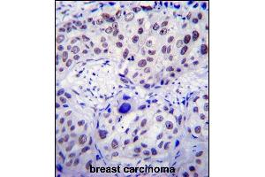USF1 Antibody (Center) (ABIN655030 and ABIN2844661) immunohistochemistry analysis in formalin fixed and paraffin embedded human breast carcinoma followed by peroxidase conjugation of the secondary antibody and DAB staining. (USF1 Antikörper  (AA 174-201))