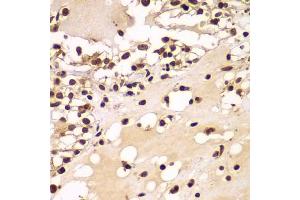 Immunohistochemistry of paraffin-embedded human kidney cancer using ZNF20 antibody  at dilution of 1:100 (40x lens). (ZNF20 Antikörper  (AA 1-200))