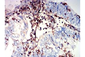Immunohistochemical analysis of paraffin-embedded endometrial cancer tissues using CD97 mouse mAb with DAB staining.