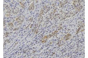 ABIN6274254 at 1/100 staining Human lung cancer tissue by IHC-P. (NBL1 Antikörper  (C-Term))