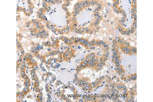 Immunohistochemistry of Human thyroid cancer using ALPP Polyclonal Antibody at dilution of 1:60